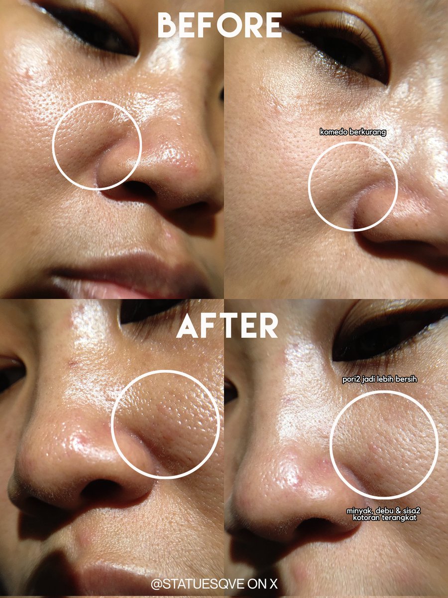 statuesqve's tweet photo. Sering aktivitas diluar pas musim panas gini, ditambah tiap hari ketemu polusi jd bikin kulitku keliatan kusam &amp; komedo numpuk.

Tapi untungnya aku punya rangkaian home peeling ini. Rasanya kaya lg facial tp versi sat setnya.

Recommended buat yg super sibuk👌🏻 
#racuninskincare https://t.co/PMOgEvtPIF