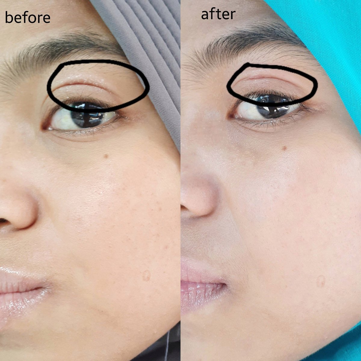 NYESEL BANGET !!
kenapa baru sekarang aku cobain day and night cream ini😭

cuma dengan dua produk udah bikin bekas jerawat aku memudar✧.°

#SimpleSkincare #RacuninSkincare