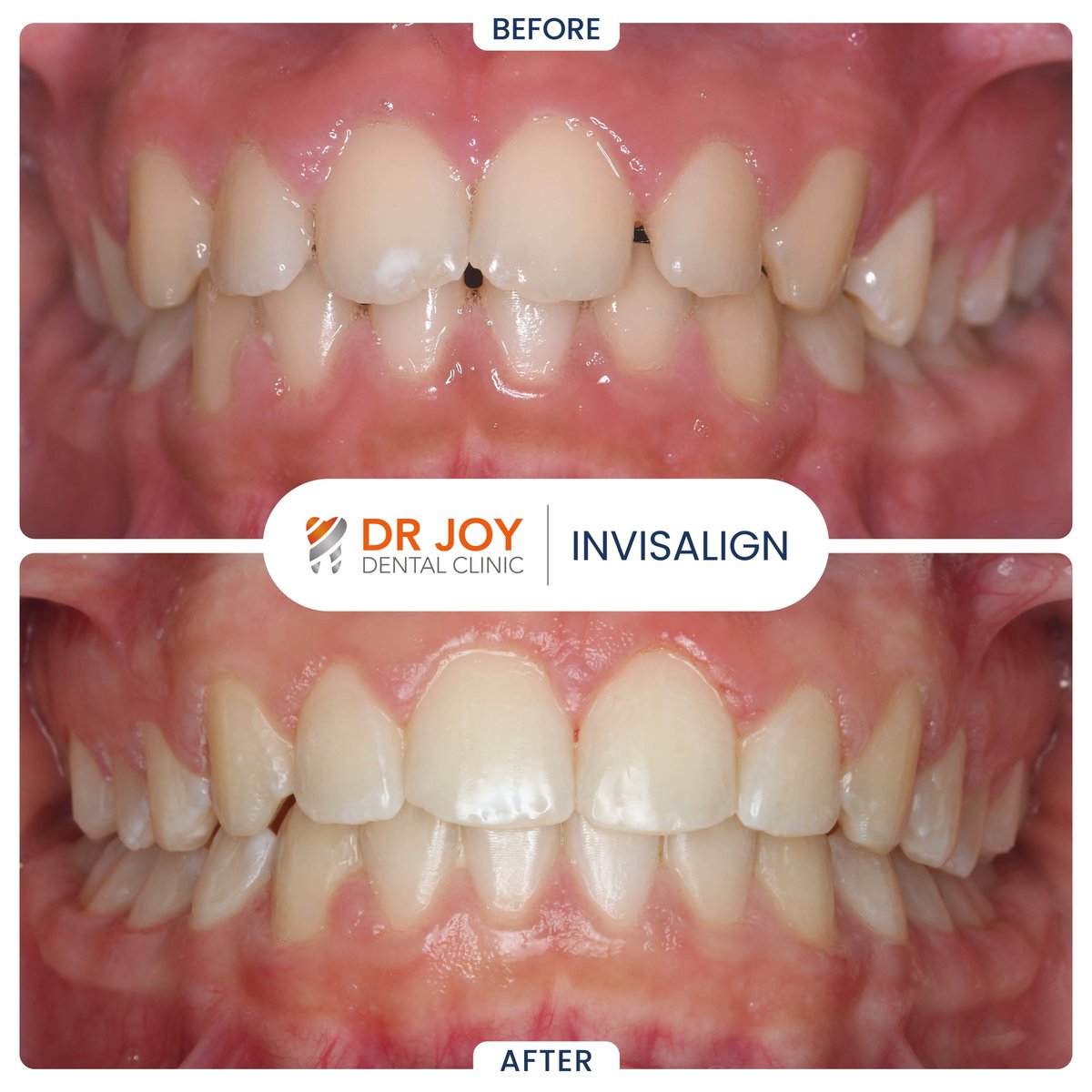 doctorjoydental's tweet image. Those bothersome gaps between the teeth were so easily closed by Invisalign by our specialist orthodontist Dr Basel.

#Invisalign #clearaligners #invisalignprovider #Dentist