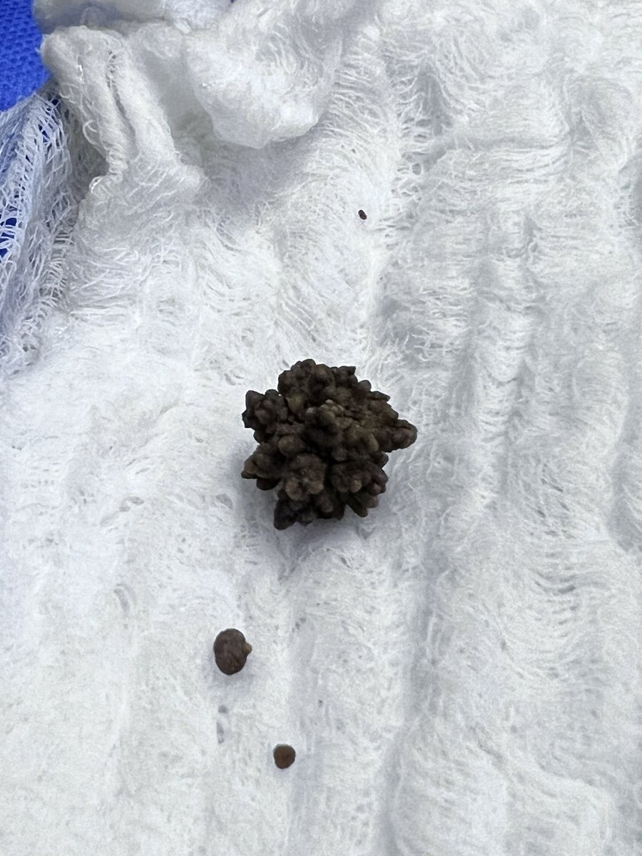 WestendarpM's tweet photo. Big prostates (125grs) + bladder stones in perhaps the only limitation for bipolep. In such cases I prefer a fast, simple and effective open adenectomy. Any opinion?
#aeep #bipolep #bph
@GoumasUrologia @gramirezwosnuk @HugoLopezRamos @Moser_DanielC @filialendouro https://t.co/gg5VaKVMSy