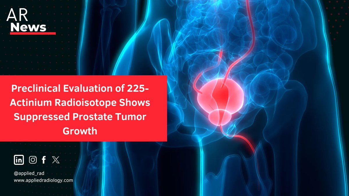 📢 Exciting Medical News! Blue Earth Therapeutics' 225Ac-rhPSMA-10.1 shows excellent potential for prostate cancer treatment with high PSMA binding, cellular internalization, and tumor suppression.

Learn More ➡️ bit.ly/3ZmgANW 

#EANM23
