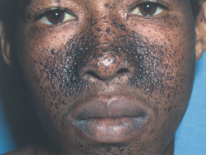dermatology's tweet photo. Diagnosis and treatment?  Source: DermNet https://t.co/THkzSZsTy5