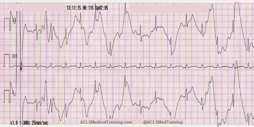 md1talk's tweet photo. ال ECG اللي تدرسونه بالجامعه 

vs 

ال ECG اللي تشوفونه اول ما تنزلون المستشفى 😅 https://t.co/uN6B6ey5eX