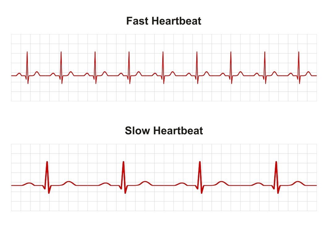 md1talk's tweet photo. ال ECG اللي تدرسونه بالجامعه 

vs 

ال ECG اللي تشوفونه اول ما تنزلون المستشفى 😅 https://t.co/uN6B6ey5eX
