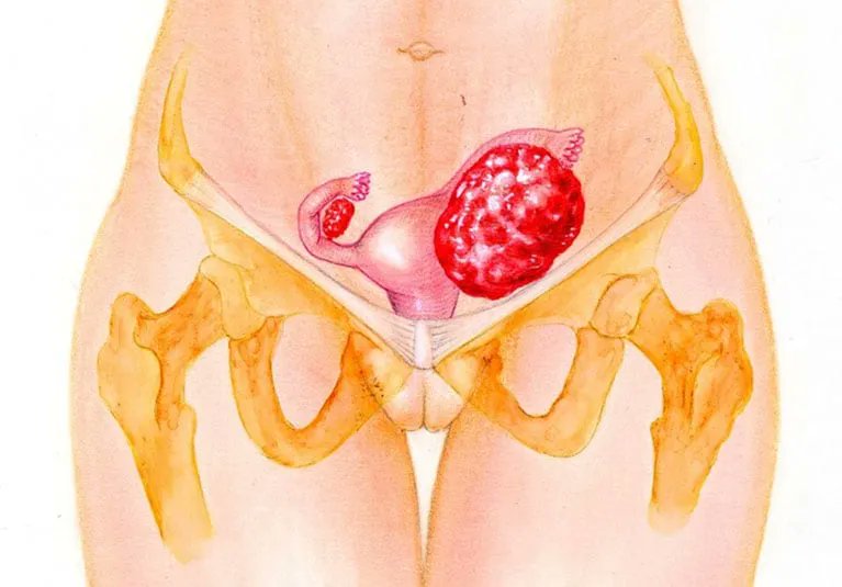 National Hereditary Cancer Week is here. Get clarity on caring for those with genetic mutations linked to ovarian cancer from an expert OBGYN PA. Read the Q&amp;A: buff.ly/3sJ1pCf #hereditarycancer #OvarianCancer #GeneticHealth #CancerCare #AskTheExpert #WomensHealth