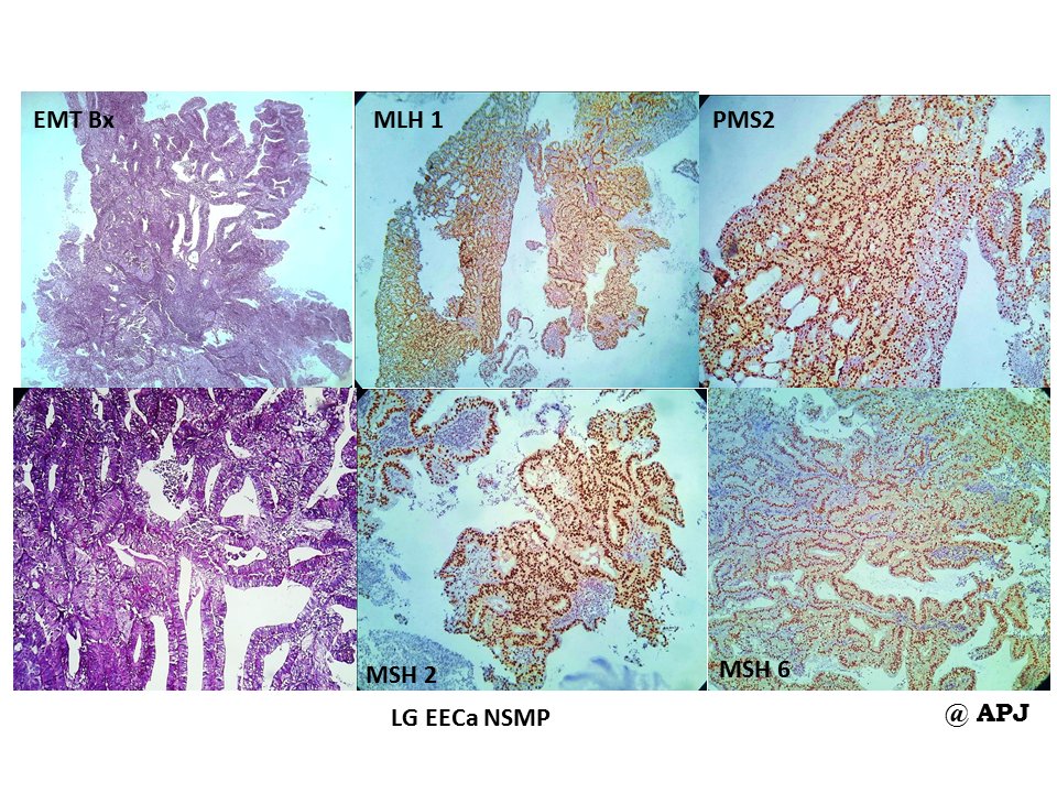 anitajawalgi's tweet photo. #KAPCON2023 #KAPCONPathX2023
#PathTwitter #pathology
Sharing microphotograph of molecular subtypes of endometrial carcinoma (WHO 5th edition latest updates)
Disclaimer: these are institutional cases for educative purpose
Pls don't misuse otherwise https://t.co/y9VIvyoE93