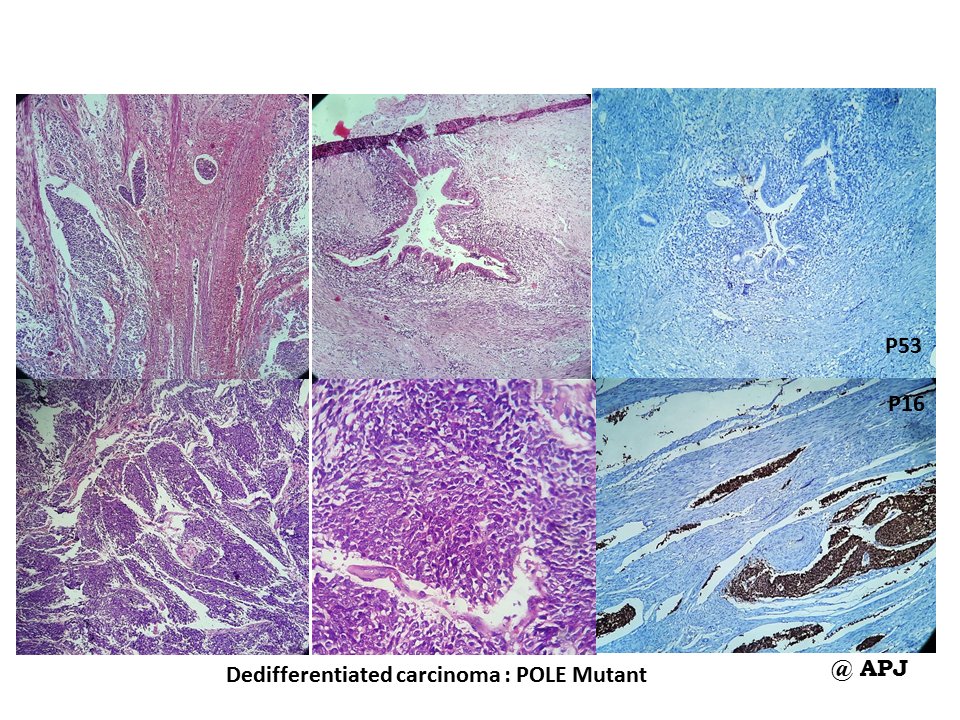 #KAPCON2023 #KAPCONPathX2023
#PathTwitter #pathology 

Sharing microphotograph of molecular subtypes of endometrial carcinoma (WHO 5th edition latest updates)
Disclaimer: these are institutional cases for educative purpose 
Pls don't misuse otherwise