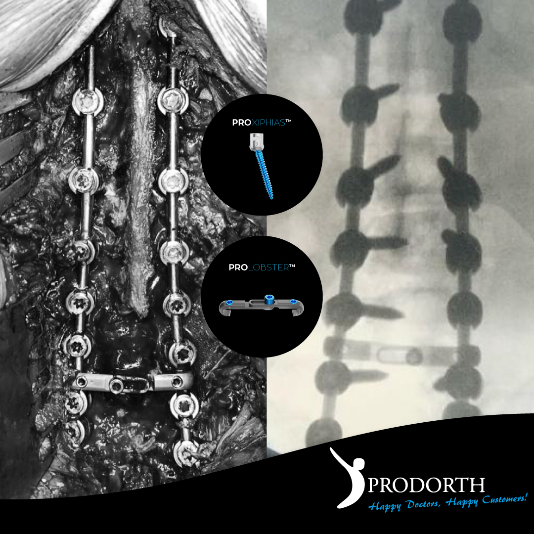 📌 Posterior Fixation Systems

🎯 Pedicular Screws - PROXIPHIAS™️
🎯 Multiaxial Connector - PROLOBSTER™
🎯 Titanium Rod

📍 Mexico

#prodorthspine #spinehealth #spinesurgery #spinedoctor #spinedevice #spineimplants #surgeryinstruments #spinesurgeryinstruments