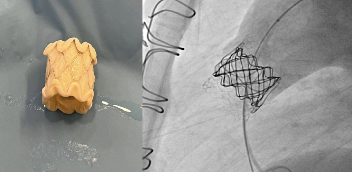 Pulmonary ViV implantation with a doubly folded Melody TPV for safe anchoring in a large bioprosthesis