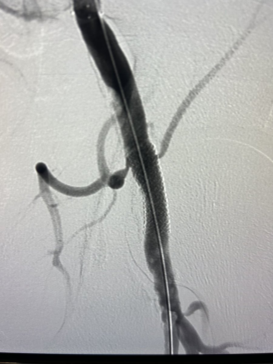 Fixed this blockage and gave patient back his day job/running. PAD remained most under diagnosed debilitating condition. This patient had under gone two back steroid injection - none helped till I fix this femoral artery blockage ⁦@baileyannRN⁩ #padawarenessmonth