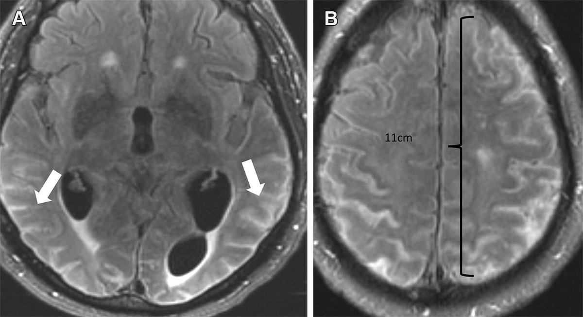 Amyloid-related imaging abnormalities (ARIA) are a potential side effect of monoclonal antibody therapies for Alzheimer disease. @amitagarwalmd @mayoradiology bit.ly/47WIbJm