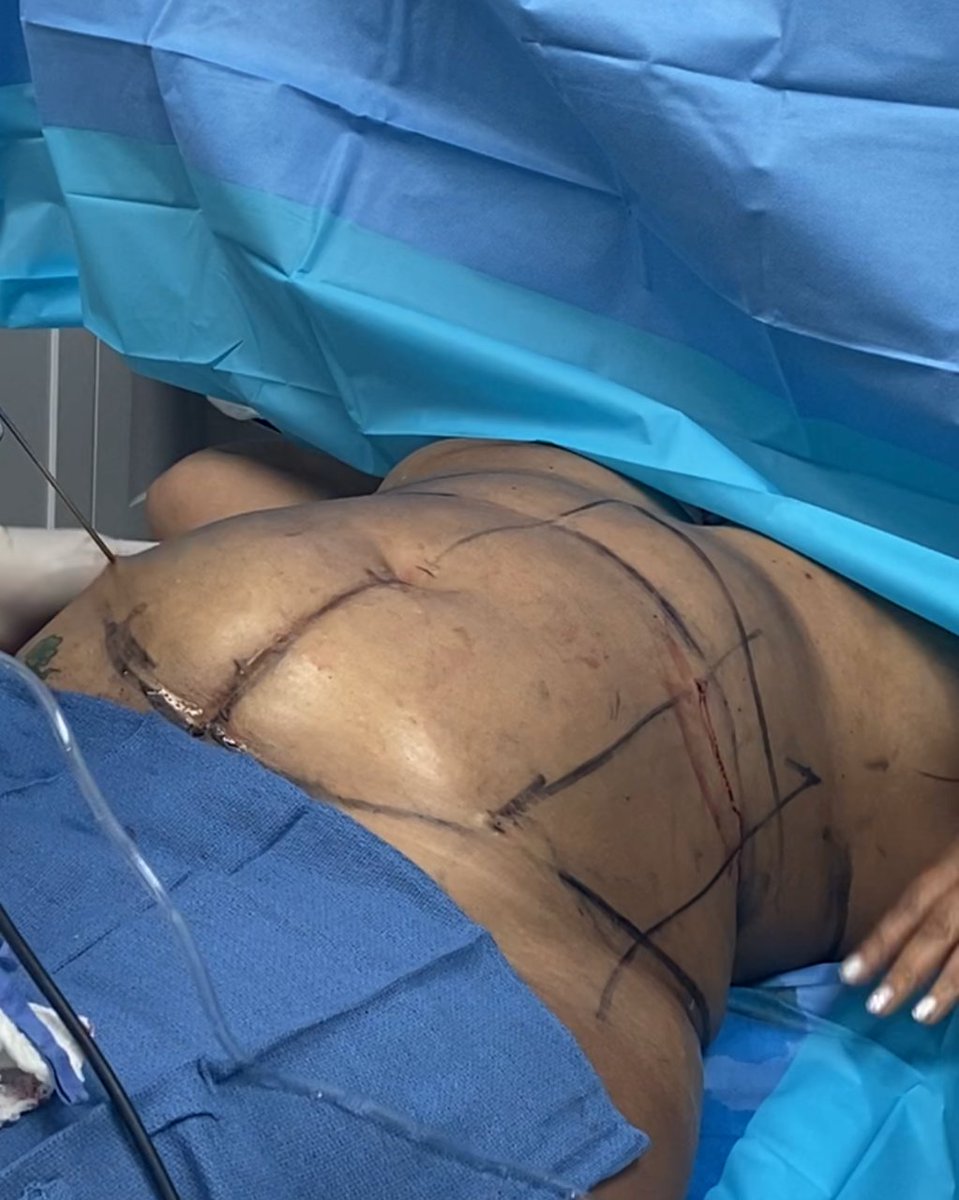 LipoSculp's tweet photo. GRAPHIC WARNING ⚠️ 
Before and after Liposuction procedure

Ready for your makeover?
LIPOSCULP
📞(844)-454-7672
📍8440 West Lake Mead Blvd Ste #111, Las Vegas NV, 89128

#lasvegas #medspa #cosmeticsurgery #lipo360 https://t.co/m41noPmOv4