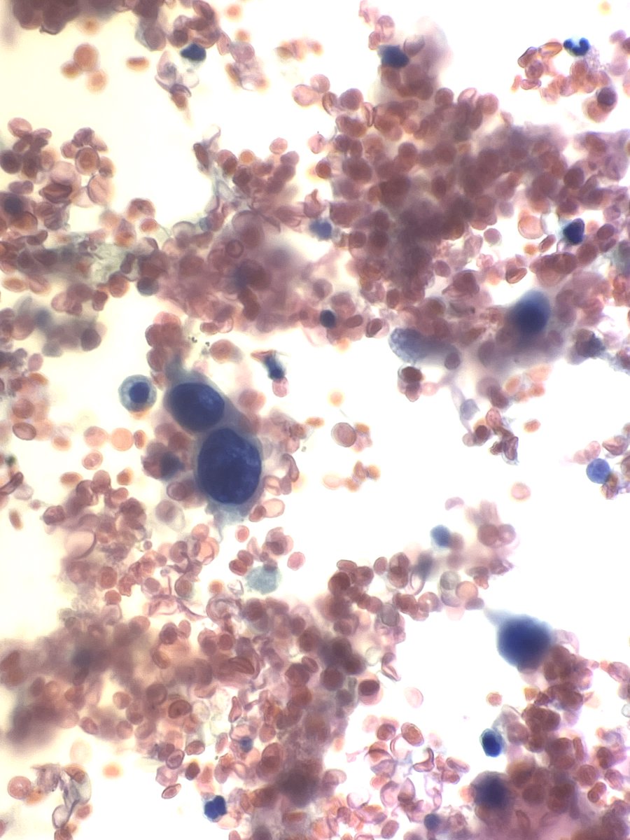 Andresangel3's tweet image. #Cytopath #FNApath #Pathology 70 y/o man with Urine cytology. History not provided. It is hemorrhagic with some atypical cells. I am very concerned. Your opinion......