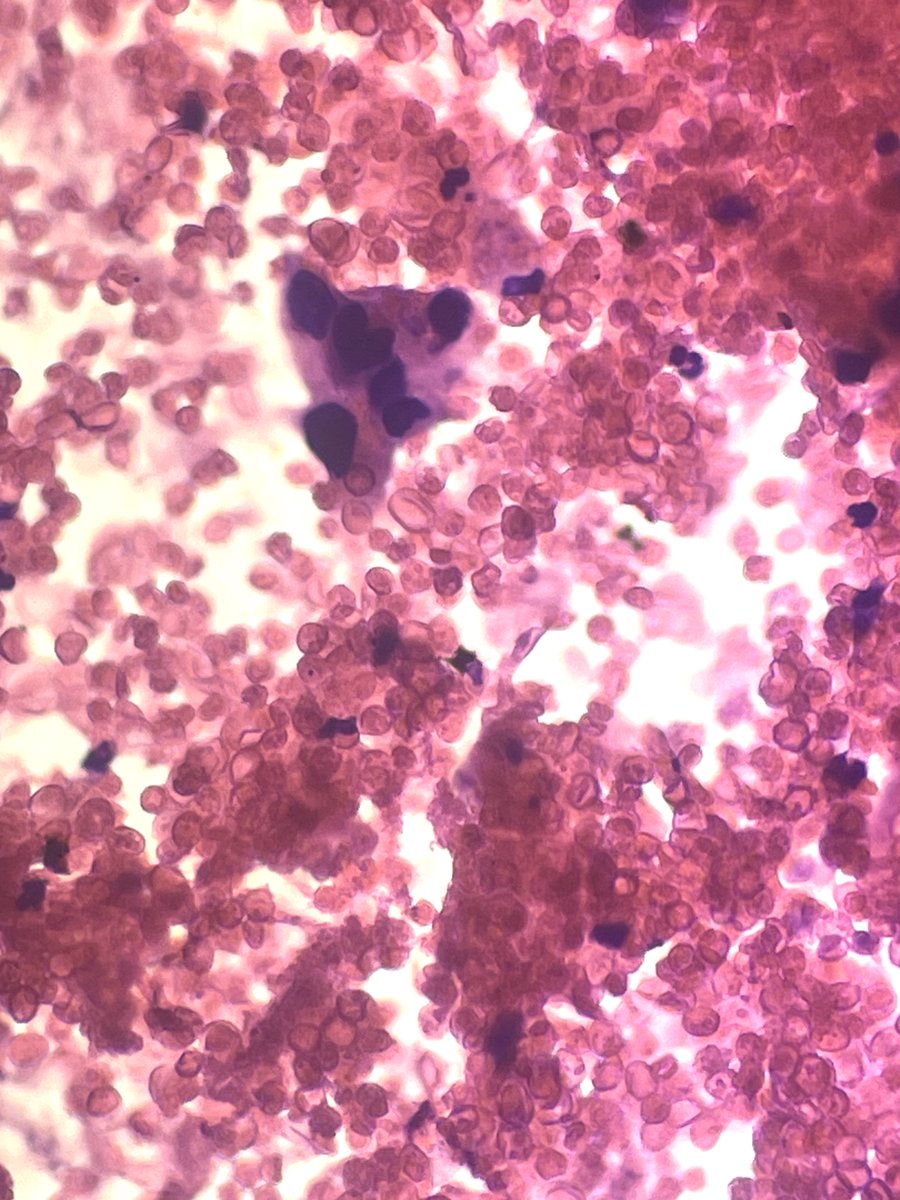 Andresangel3's tweet image. #Cytopath #FNApath #Pathology 70 y/o man with Urine cytology. History not provided. It is hemorrhagic with some atypical cells. I am very concerned. Your opinion......