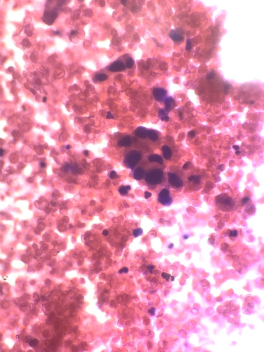 Andresangel3's tweet image. #Cytopath #FNApath #Pathology 70 y/o man with Urine cytology. History not provided. It is hemorrhagic with some atypical cells. I am very concerned. Your opinion......