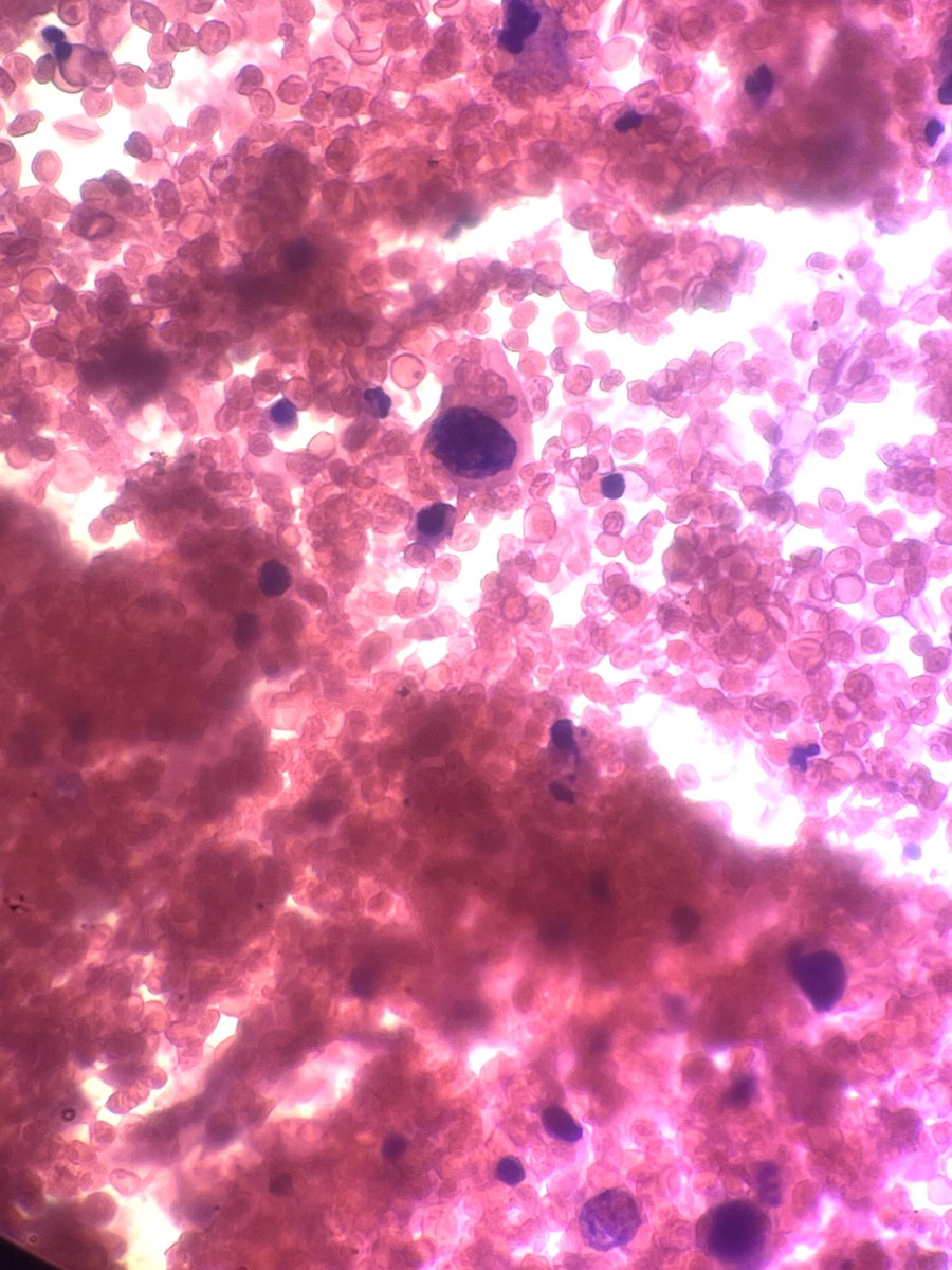 Andresangel3's tweet image. #Cytopath #FNApath #Pathology 70 y/o man with Urine cytology. History not provided. It is hemorrhagic with some atypical cells. I am very concerned. Your opinion......