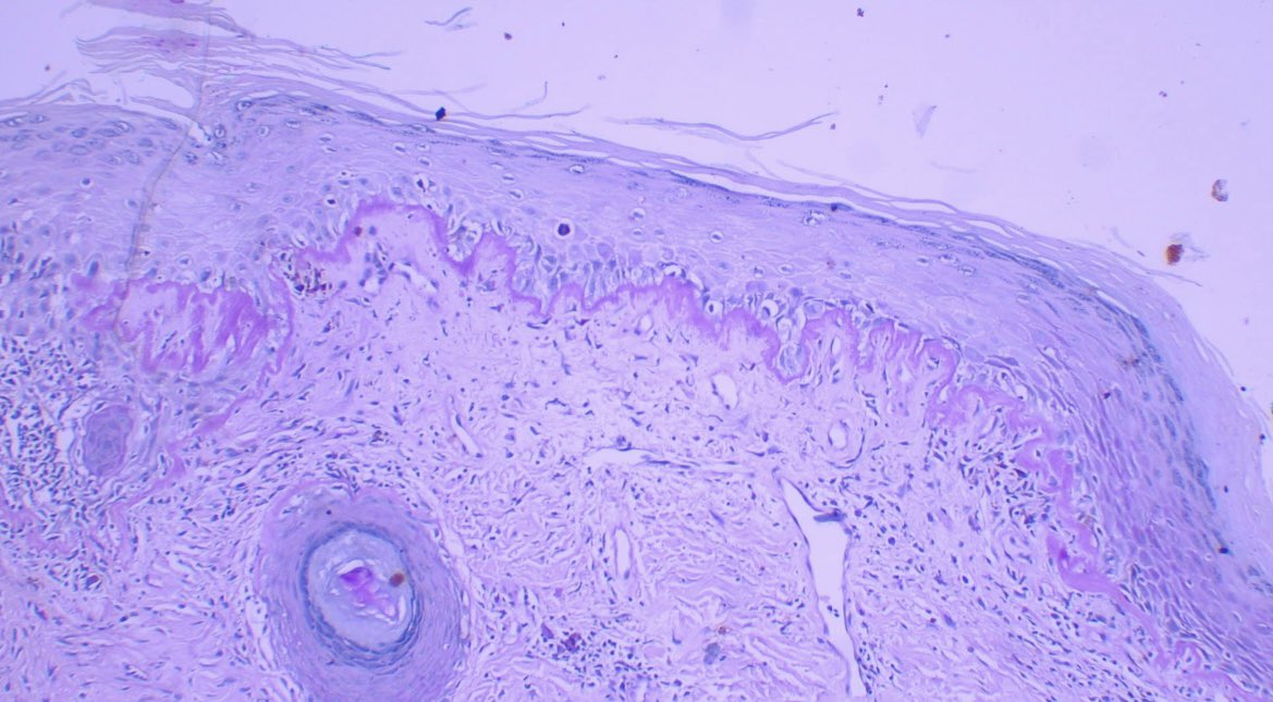 Tickened basal membrane. #lupus PAS staining just for fun 😁 #dermpath #pathology #pathtwitter #patología #patologia #dermatology #dermpath