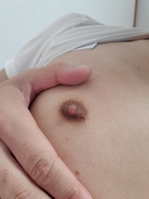 先週水ぶくれになってたところが少し良くなってきた！ もう痛みもないから、後は自然に治るのを待とうかな&hellip; https://t.co/uLaS26IJq2<a href="/tag/myxanniversary"class="tags"><span>#myxanniversary</span></a>