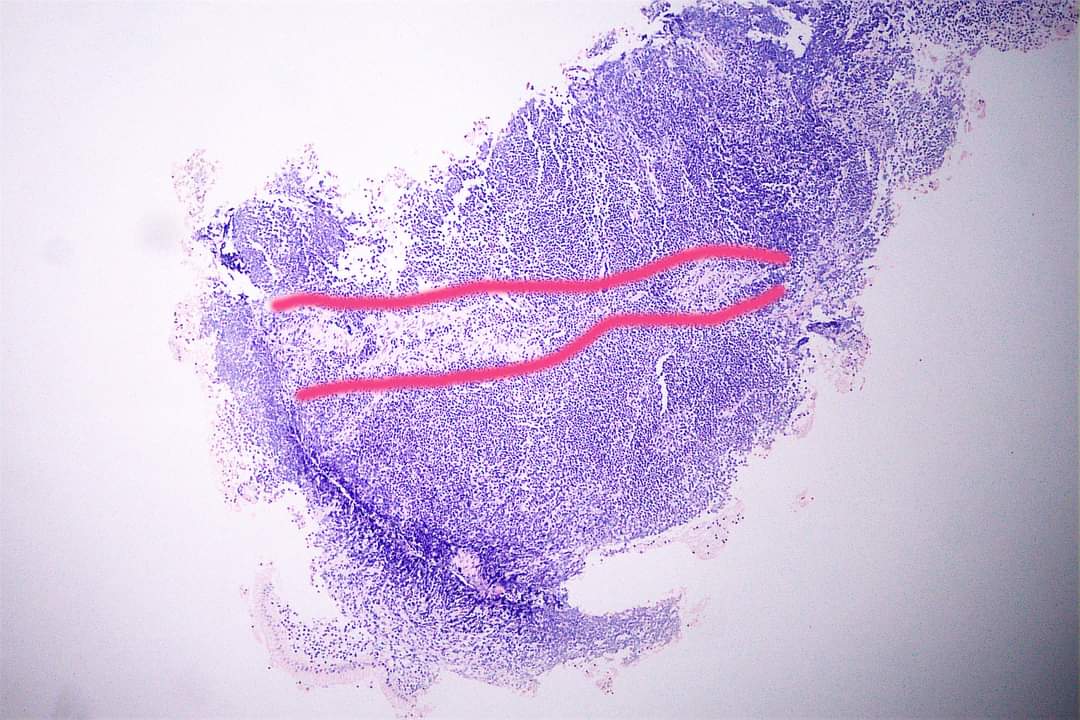 GeronimoJrLapac's tweet photo. 🔥A TIP for diagnosing MALT Lymphoma starts with low magnification. 
🎯I search for the muscularis mucosa and see it at the highest magnification.
👉Physiologic lymphoid collection typically does not infiltrate the muscularis mucosa.
Here is a gastric MALT Lymphoma.

#gipath https://t.co/dpMFtOpGvk