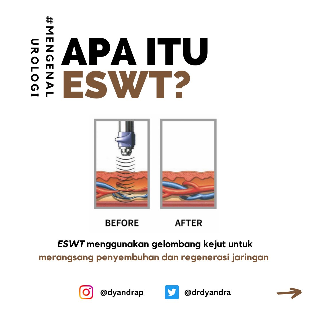 drdyandra's tweet photo. 🌟 Edukasi Urologi: Extracorporeal Shockwave Therapy (ESWT) dalam Terapi Disfungsi Ereksi, Prostatitis, dan Penyakit Peyronie 🩺💡
#EdukasiUrologi 
#ESWT 
#KesehatanPria 
#DisfungsiEreksi 
#Prostatitis 
#Peyronie
#TerapiKesehatan
#mengenalUrologi
#urologi
#Kesehatan 
#konsultasi https://t.co/yBocJ9hoAi