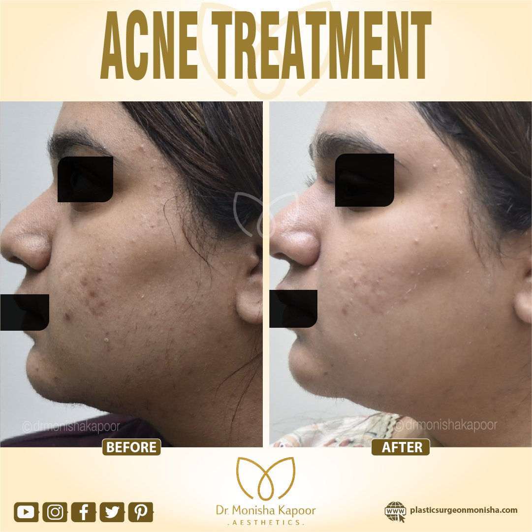 Say Goodbye to Acne: The Powerful Combination of ZO Skincare, Hydra Facial, and Laser Toning!
cosmeticlaserclinics.com/other-skin-con…
#Acne #Pimples #DarkSpots #Skincare #ClearSkin #AcneTreatment #SkinCareRoutine #HealthySkin #GlowingSkin #skincare  #Blemishes #AcneSolutions #SpotTreatment