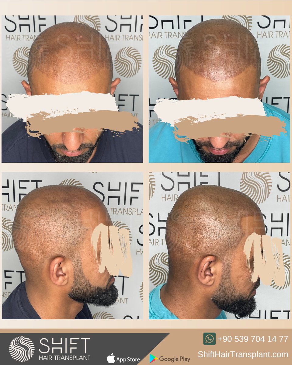 shifthairtr's tweet image. Before and after scalp micropigmentation in Istanbul with SHIFT in Turkey

#scalpmicropigmentation #micropigmentation #smp #hairtattoo #hairshading #micropigmentationturkey #micropigmentationistanbul #micropigmentationinturkey #micropigmentationinistanbul #micropigmentationartist