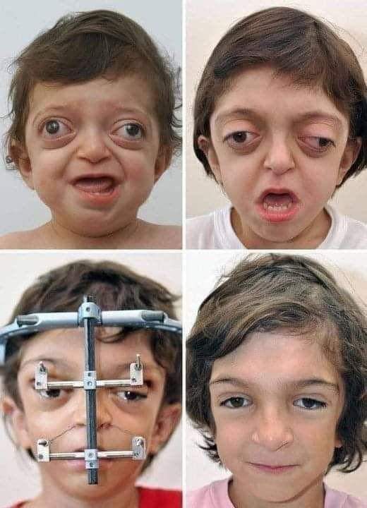 Doctors have done an incredible job for this young boy with Crouzon Syndrome, guiding him through facial reconstruction.🙌🏾💥

The marvels of modern medicine are astonishing. He's such an adorable kid! 😍

Much respect to these brilliant surgeons for their exceptional work! 🙏