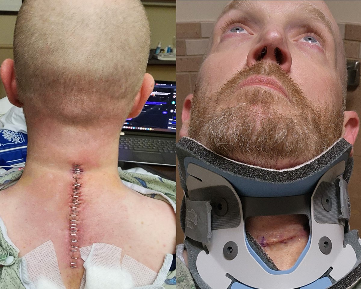 Non-Small cell lung adenocarcinoma metastasis has no cure &amp; is the #1 cause of cancer death in the US.

*ACS  has the 5-year survival rate for metastatic
Stage 4b NSCLC at about 3%

both lungs, spin, rib cage &amp; lymph system

Prayers &amp; Miracles Welcome #crofam &amp; NFT 🙏Community