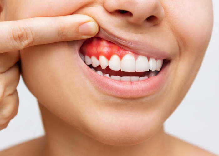ManorHouseYork's tweet photo. Don’t ignore bleeding gums, as they often signal gum disease – or advanced gum disease, known as periodontal disease. 

Avoid expensive complications by getting gum disease treatment early.

Learn more.

https://t.co/tLLXTfeouE

#ManorHouseDental https://t.co/whDaMvPwmy
