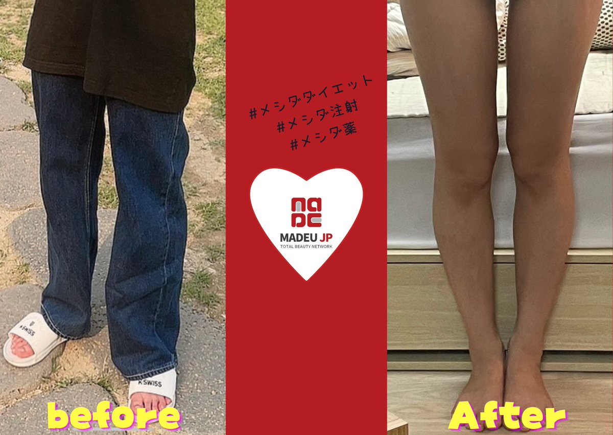 madeujp's tweet photo. 📷メイドユーお客様レビューフォト
メシダ注射💉&メシダ薬💊
体型を隠す服装をしていたというお客様。メシダ注射と薬のダブルアタックで術後すぐでも効果を実感いただけました🩷
#メイドユー #ダイエット #ダイエット薬 #韓国ダイエット #MADEU #ダイエット注射 #メシダ薬 #メシダ注射 https://t.co/3084NfWY0B