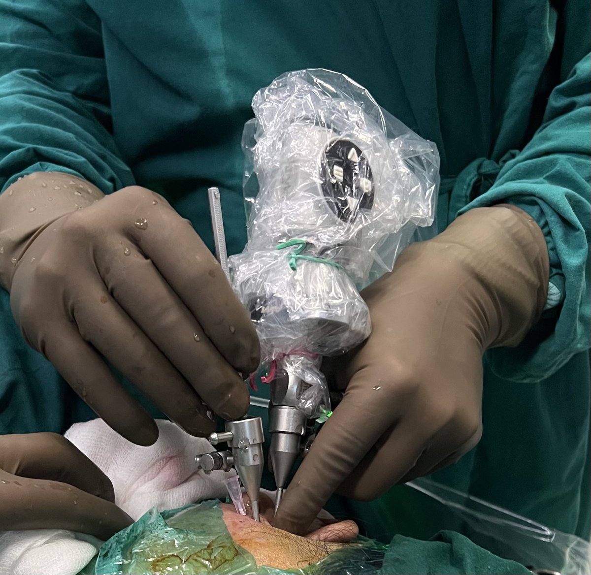 TMJ arthroscopy, also known as temporomandibular joint arthroscopy, is a minimally invasive surgical procedure used to diagnose and treat issues related to the temporomandibular joint (TMJ). Here are some benefits of TMJ arthroscopy:

1. Minimally invasive: Compared to open joint