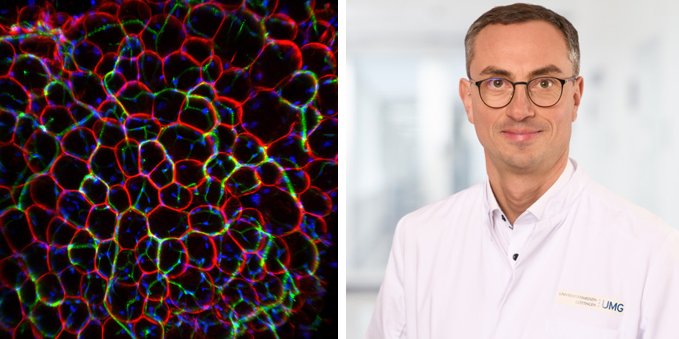 Publikation im renommierten "Nature Cancer": Forscher*innen der UMG entdecken Ansatz, um Verlust von Fettgewebe bei Krebserkrankung aufzuhalten 👩‍🔬🧑‍🔬Wir gratulieren dem Team um Prof. Andreas Fischer, Direktor des Instituts für Klinische Chemie der UMG, herzlich zum Erfolg! 👏💐