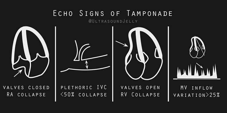 ImagineerMD 🧠 (@imagineermd) on Twitter photo 💡Echo Signs of Cardiac Tamponade
Love the visual. Simple & directs the viewers focus to the key findings by eliminating distracting detail.
Perfect for #EMBound ultrasound learners from beginner to advanced.
Credit: <a href="/coreultrasound/">Jailyn/Ben</a> 💡Echo Signs of Cardiac Tamponade
Love the visual. Simple & directs the viewers focus to the key findings by eliminating distracting detail.
Perfect for #EMBound ultrasound learners from beginner to advanced.
Credit: <a href="/coreultrasound/">Jailyn/Ben</a>