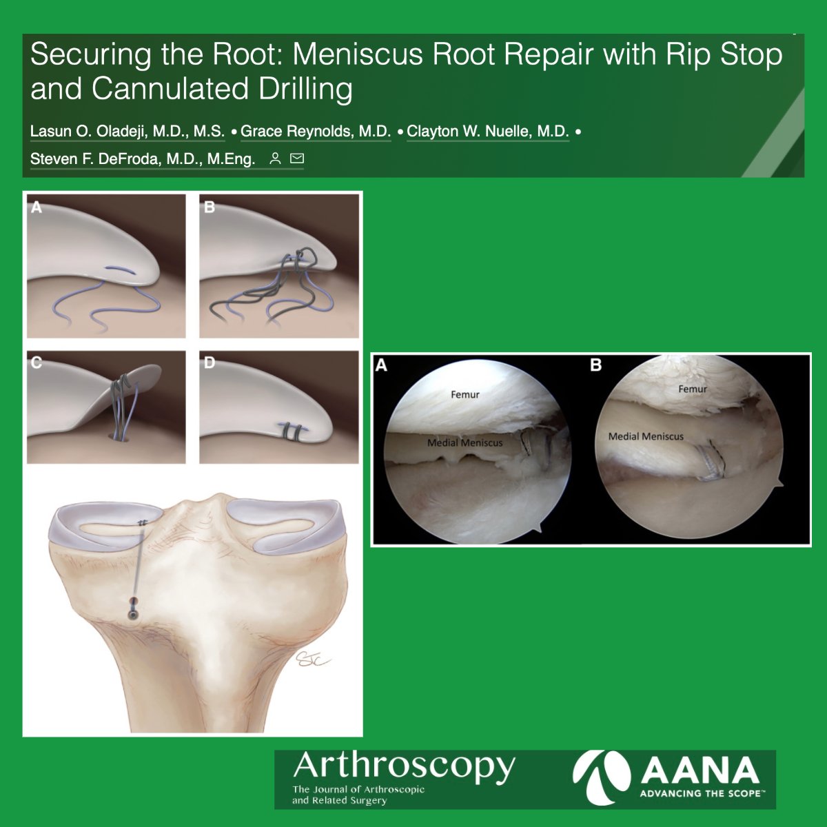 Arthroscopy Journal (@arthroscopyj) on Twitter photo Want to Add a Rip Stop To Your Root Repair? Find Technical Pearls and Pitfalls in This Article ow.ly/XRAP50PP0vK @SDeFrodaMD <a href="/NuelleSportsMD/">Clayton Nuelle, MD, FAAOS</a> Want to Add a Rip Stop To Your Root Repair? Find Technical Pearls and Pitfalls in This Article ow.ly/XRAP50PP0vK @SDeFrodaMD <a href="/NuelleSportsMD/">Clayton Nuelle, MD, FAAOS</a>