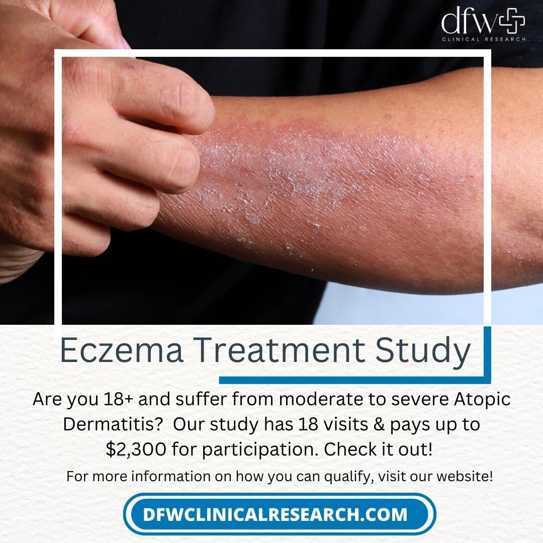 Ready to reclaim your skin's comfort? Our Atopic Dermatitis Clinical Study is here to support you.

Connect with us at 469-225-5800 or go to dfwclinicalresearch.com to learn more about our study and how you can participate. 🌼🌈

 #GetPaid #eczemaresearch #atopicdermatitisstudy