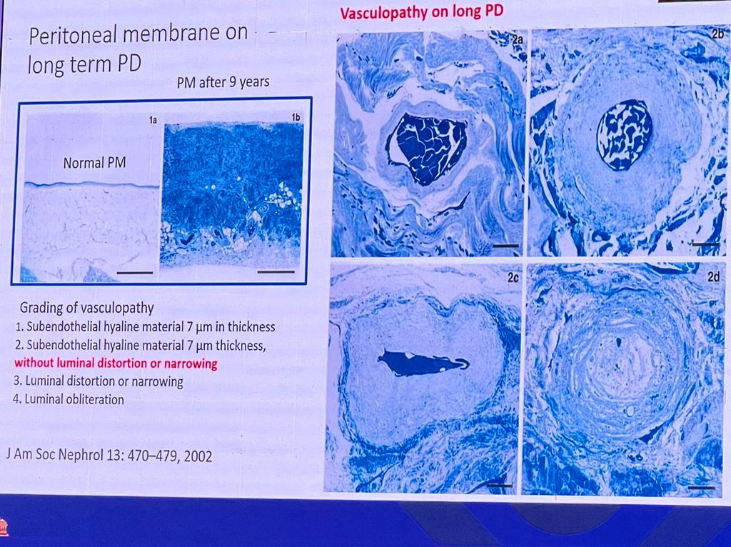 nyiminhan's tweet photo. 8/10
🔆 Inflammation and its consequences are also contributed in PD membrane failure #ispd23 https://t.co/v1wpcKWva1