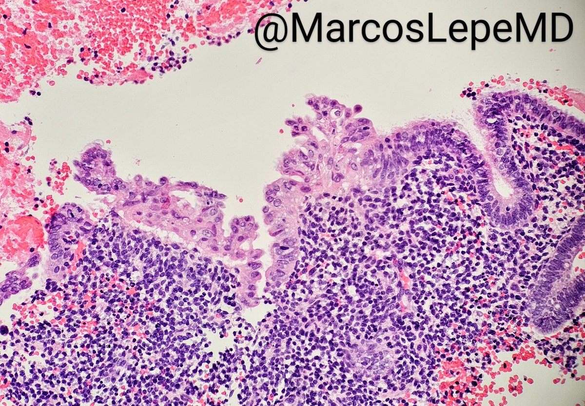 Oh brave and wise tweeples!🗣️🔊📢
When you learned endometrial biopsies, what were you told this change is called?

It goes by many names!

#Gynpath #pathology