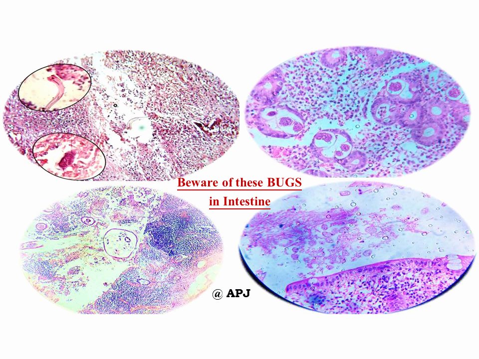 anitajawalgi's tweet photo. #KAPCON2023 #KAPCONPathX2023 #PathTwitter #pathology
Sharing microphotograph of "Bugs bothering bowel "
Identify the bugs n ping me
Enjoying Xing and reXing https://t.co/nsHwBOjUQK
