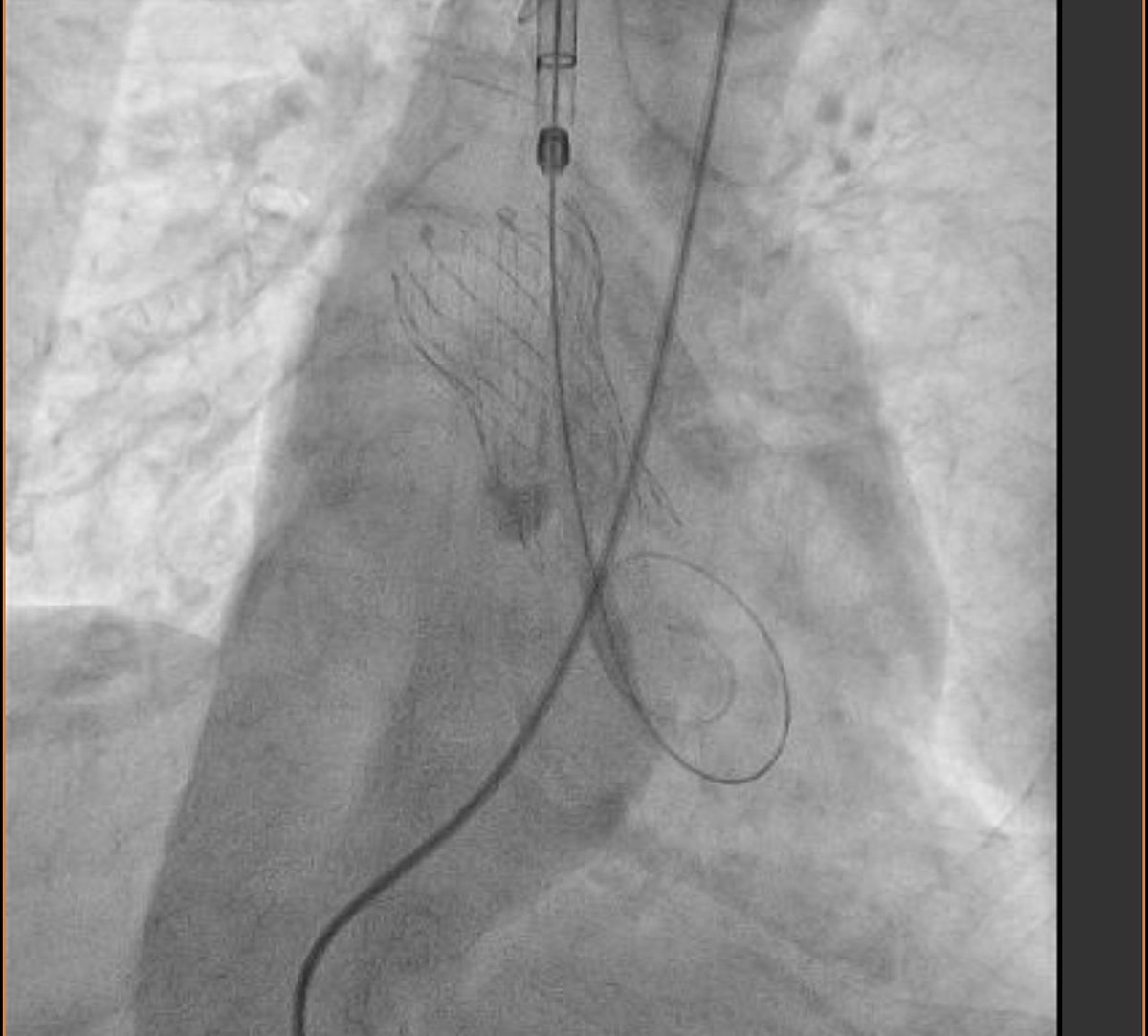 Primer Implante Valvular Aórtico Transcarotideo Exitoso Con válvula CoreValve Evolut Pro +  con Delivery System el IADT a la vanguardia en el tratamiento de la Cardiopatía Estructural  .   Agradecimiento a todo el gran equipo que lo hizo posible !!!❤️