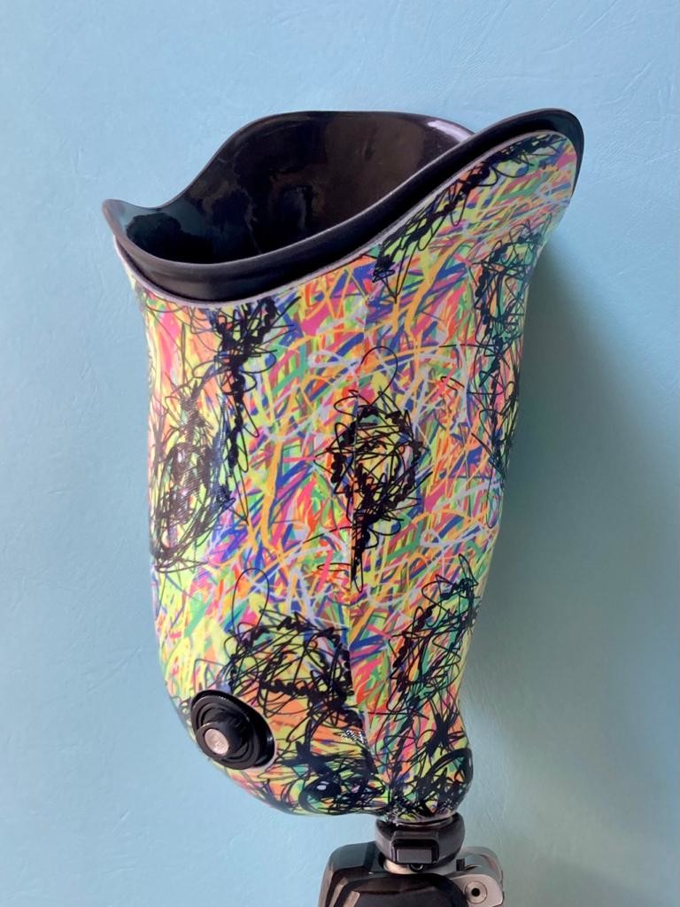 ProActive4Rehab's tweet image. 🤩 wow take a look at this! This amazing socket has been expertly laminated by our fab team of Technicians. One of the most eye-catching designs we have seen lately!
#socketdesign #sockettech #sockettechnology #prostheticlegs #prostheticsocket