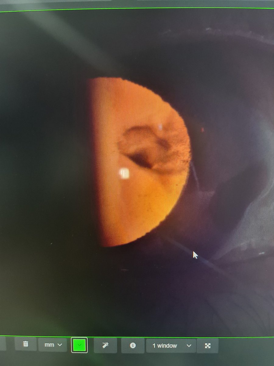 Paciente acuede a consulta por mala AV, se observa esto en la exploración, hay algo que llama la atención,  y explica el por qué de la catarata... 👁👁👀👀