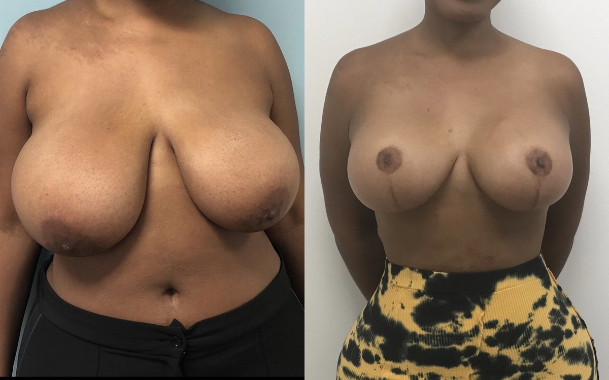 RealDrOPP's tweet photo. Uncensored breast reduction and implants 😯 https://t.co/YoIjgCiMsw