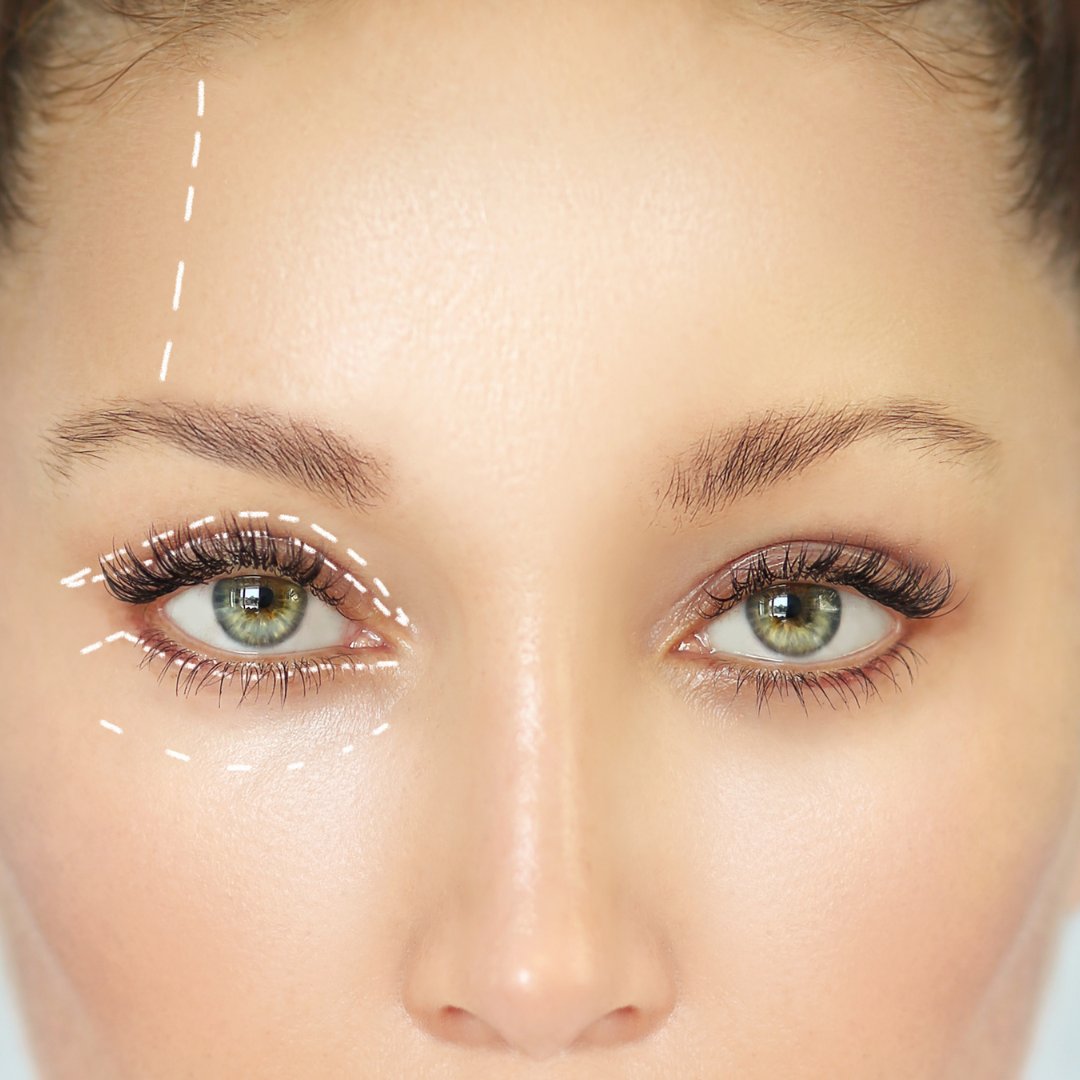 Upper Eyelid Blepharoplasty

Click for more: 1l.ink/C3JDK58

#AdvancedCosmeticSurgeryandLaserCenter #351Face #Botox #CosmeticSurgeon #Cincinnati #Ohio #PlasticSurgeon #MedicalSpa #Fillers #Skincare #Injectables #LaserTreatments #EyelidSurgery #Liposuction #Blepharoplasty