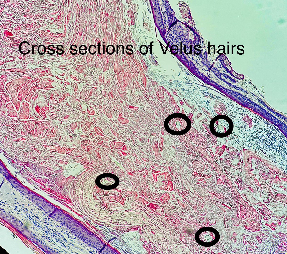 Velus hair cysts —> occlusion of the upper (infundibulum) portion of the velus hair follicle —> dilation +\- eruption. 

Oftentimes in chest. 

See velus hairs cut in cross section 👇 

#pathagonia 
#pathx #medstudentx #dermx #dermpath #cysts #familymed