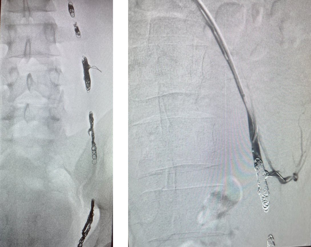 Peter Pattison (@bsc_io) on Twitter photo Another great day for #EMBOLDcoils. The 1st Soft coil case completed <a href="/UCSDHealth/">UC San Diego Health</a> by Dr. Jonas Redmond <a href="/JohnDoIR/">John Do</a> <a href="/Ajairam_MD_IR/">Abhi Jairam</a> <a href="/MansurGhani/">Mansur Ghani, MD</a> a combo of multiple EMBOLD coils were placed in the left testicular vein achieving occlusion in this varicocele case bit.ly/3kxyd9Y Another great day for #EMBOLDcoils. The 1st Soft coil case completed <a href="/UCSDHealth/">UC San Diego Health</a> by Dr. Jonas Redmond <a href="/JohnDoIR/">John Do</a> <a href="/Ajairam_MD_IR/">Abhi Jairam</a> <a href="/MansurGhani/">Mansur Ghani, MD</a> a combo of multiple EMBOLD coils were placed in the left testicular vein achieving occlusion in this varicocele case bit.ly/3kxyd9Y
