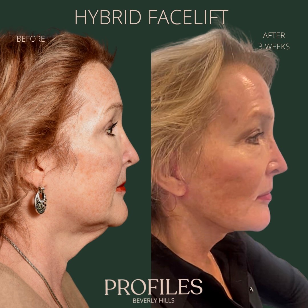 FacialPlastics's tweet photo. 📞310-276-6800​​​​​​​​​
🏠435 N Bedford Drive, PH500, Beverly Hills, 90210
👱‍♀️Profiles Hybrid Facelift
🗓Before and After 3 Weeks
🛏About 1 Week

🤩✨Wow look at that jawline!

Are you looking for a facial rejuvenation that can help you achieve a youthful appearance while mainta https://t.co/Pwf3RSl0VZ