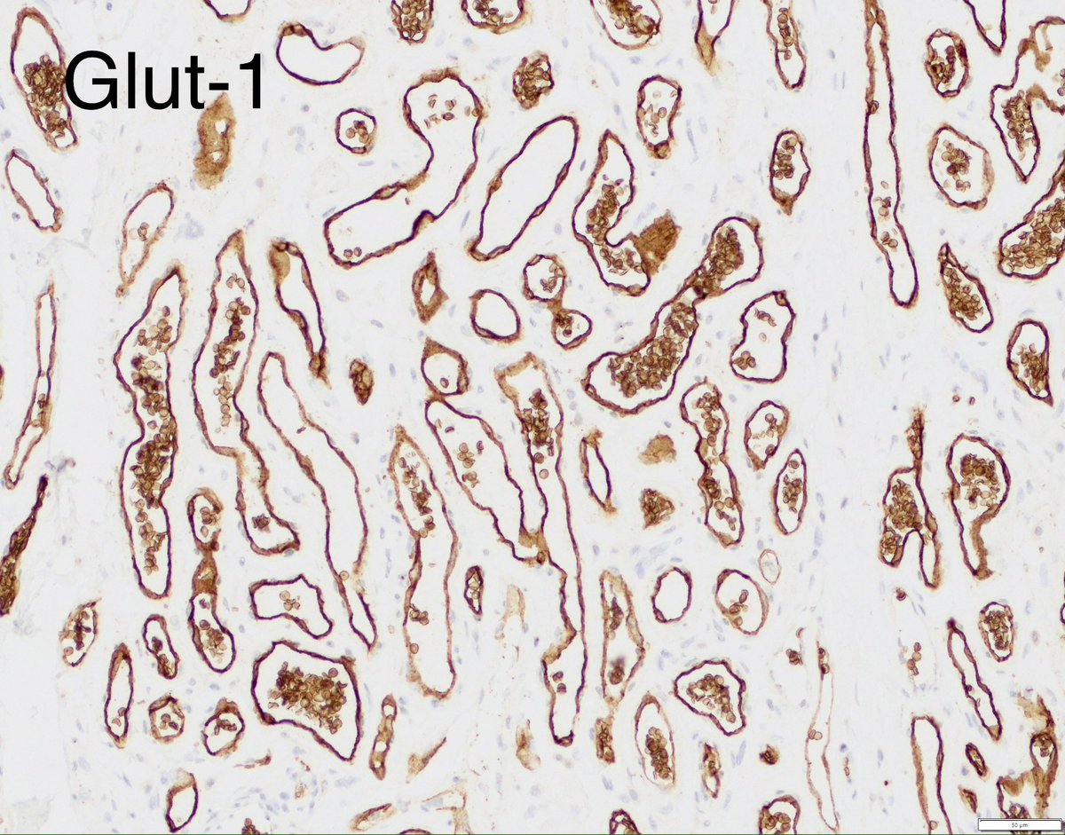 Facial skin lesion, likely diagnosis? #pedipath #bstpath #dermpath #PathTwitter #path