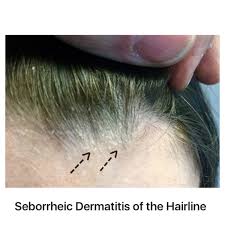 hormonedietdoc's tweet photo. #Seborrheic #Dermatitis: Is a common form of #Eczema that affects mainly the scalp. Factual cause unknown but most have #gut issues & stress. Dairy, grains, sugar & seed oils exacerbate flares 

Go all #Carnivore for 3 weeks
Magnesium Glycinate
Omegagenic Mega 10 
G.I. Revive
