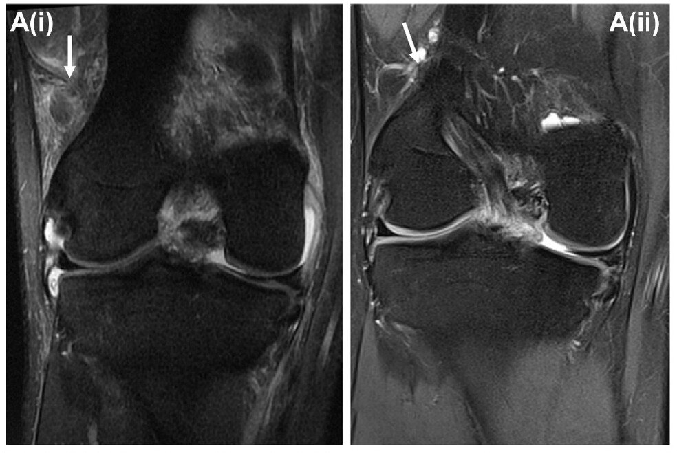 AOSSM Journals (@aossmjournals) on Twitter photo MRI-diagnosed injury to the Kaplan fibers at the time of ACL injury resolves in majority of cases 9-months following acute ACL reconstruction. <a href="/OrthoSportVic/">OrthoSport Victoria</a> <a href="/OSVResearchUnit/">OSV Research Unit</a>
ow.ly/YuG050PK3Gg MRI-diagnosed injury to the Kaplan fibers at the time of ACL injury resolves in majority of cases 9-months following acute ACL reconstruction. <a href="/OrthoSportVic/">OrthoSport Victoria</a> <a href="/OSVResearchUnit/">OSV Research Unit</a>
ow.ly/YuG050PK3Gg