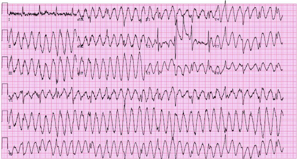 Toaster_Pastry's tweet photo. I was called to consult on a patient with ventricular tachycardia, persisting for several minutes; patient without symptoms. Cardiac rhythm has a natural order and organization. This is not "ventricular tachycardia."  Put the Amiodarone drip away. https://t.co/0WozoOOFTd